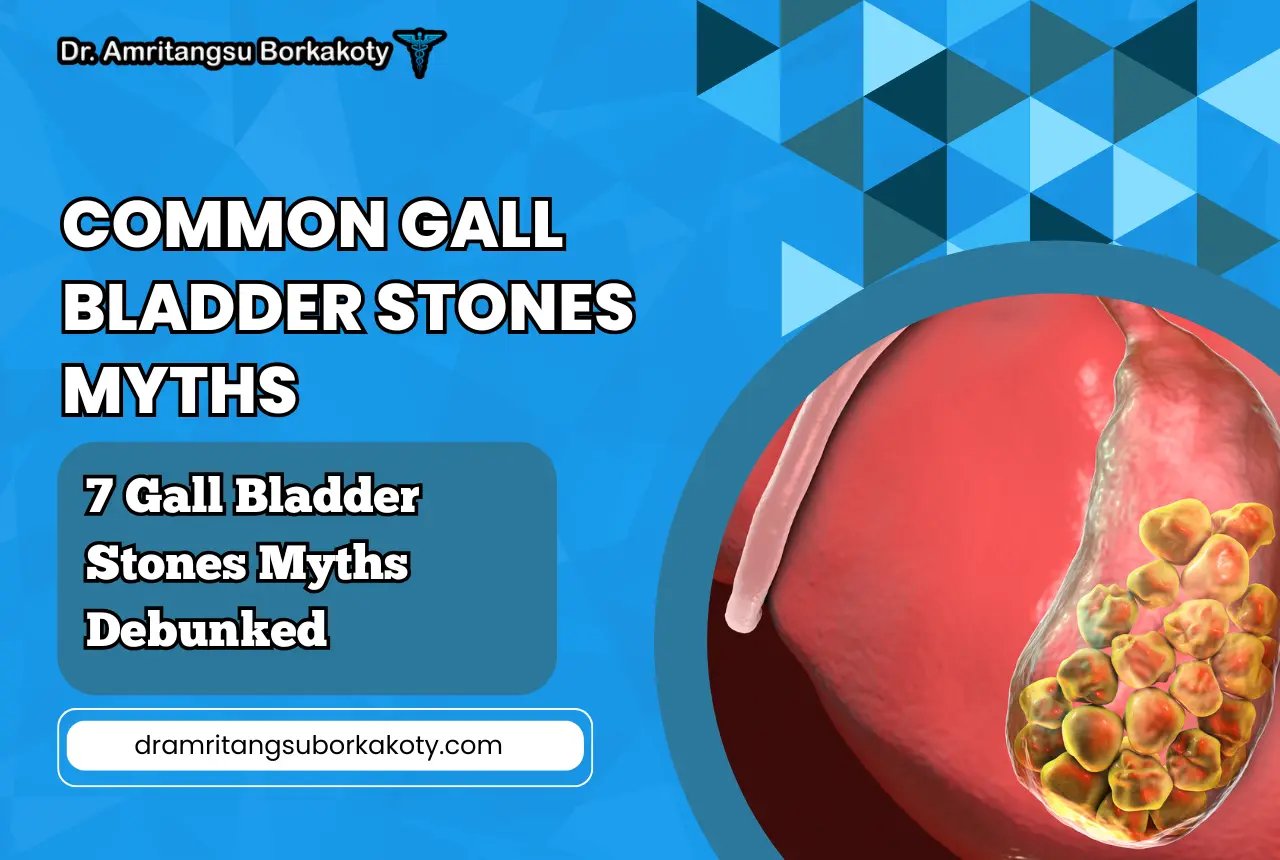 common gall bladder stones myths