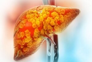 NAFLD