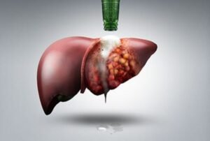 Image: Can NAFLD Cause Liver Cancer