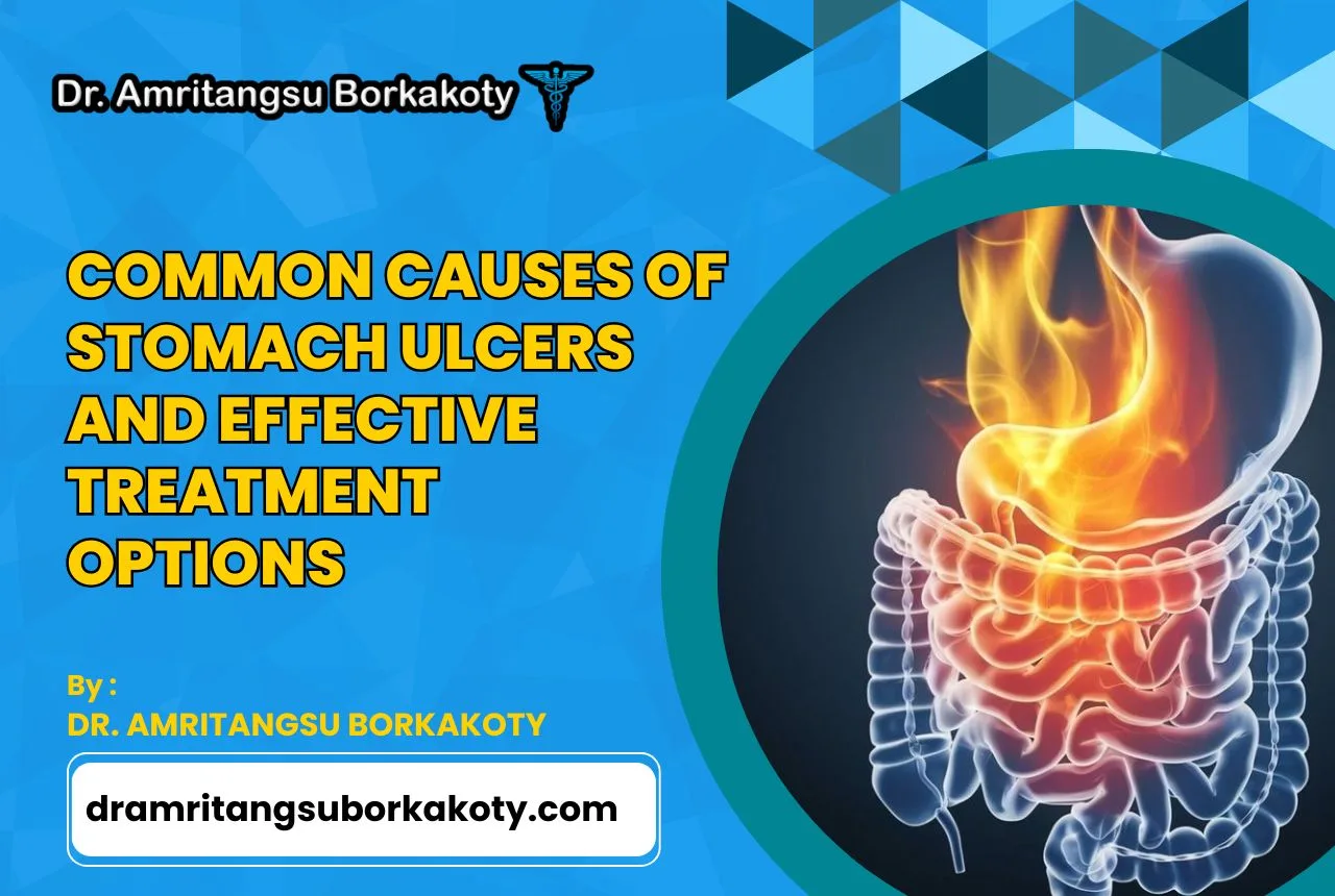 Image: Causes of Stomach Ulcers